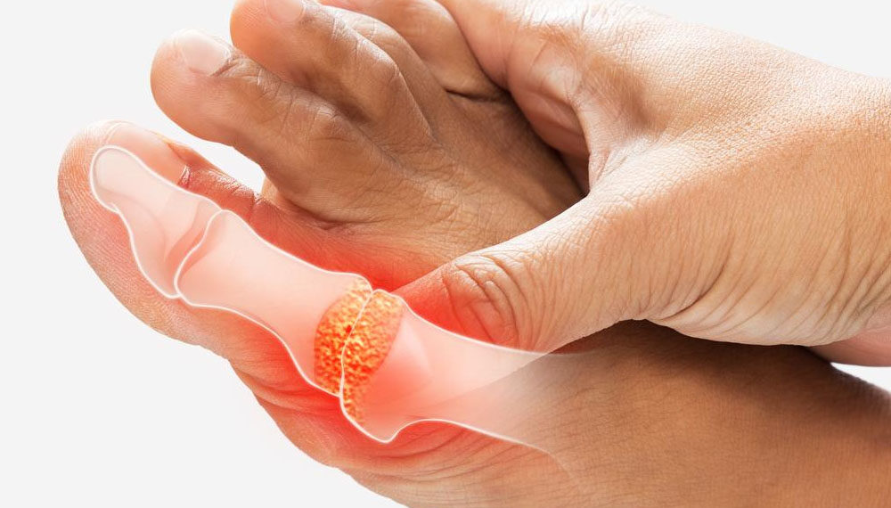 Hubungan Antara Gout Dan Pemakanan Harian
