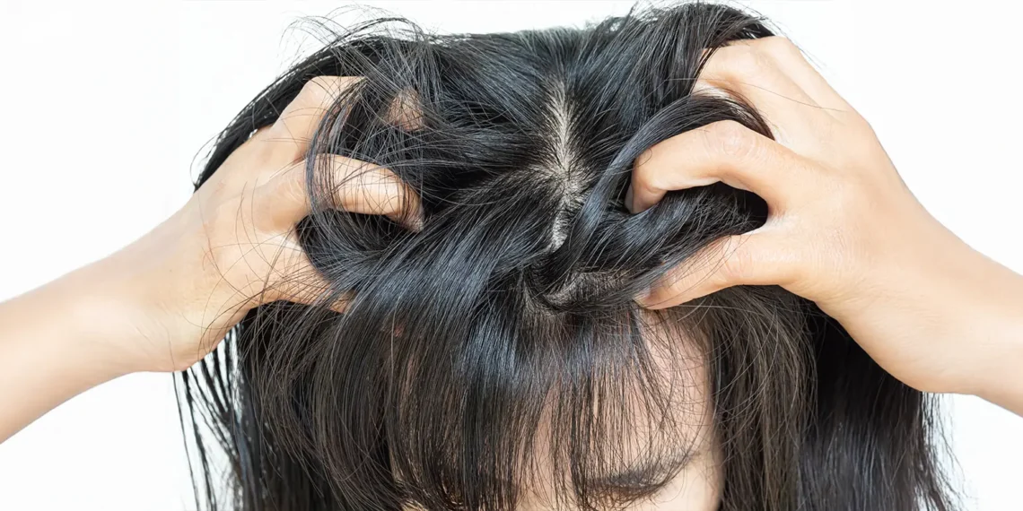 Mengapa Kulit Kepala Gatal Walaupun Kerap Basuh?
