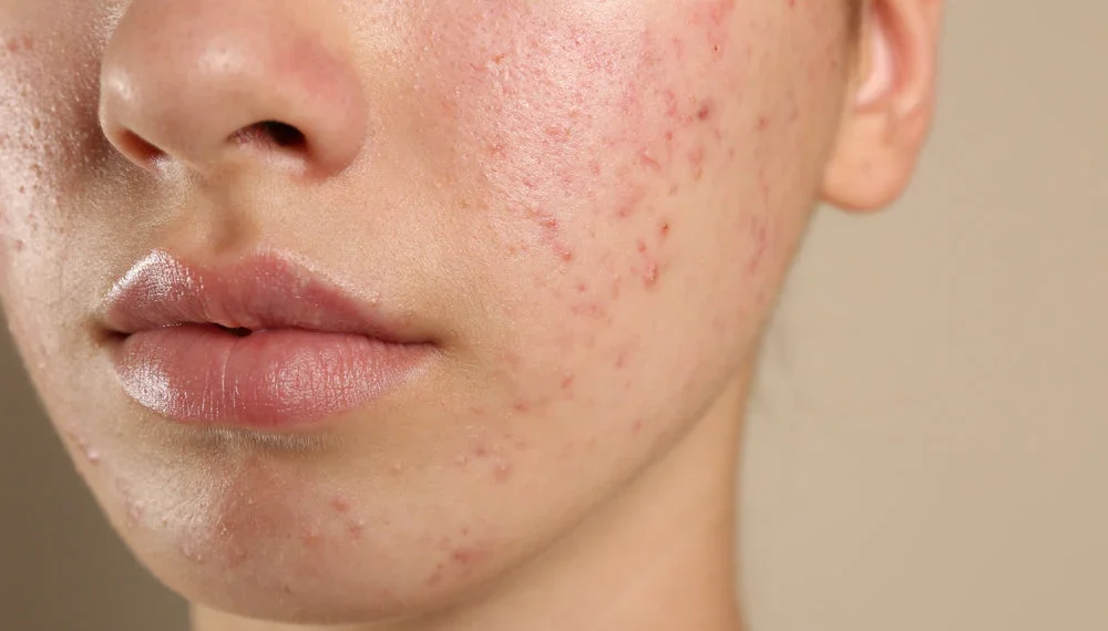 Kulit Terlampau Sensitif Terhadap Produk: Tanda Skin Barrier Rosak?