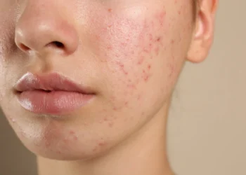 Kulit Terlampau Sensitif Terhadap Produk: Tanda Skin Barrier Rosak?
