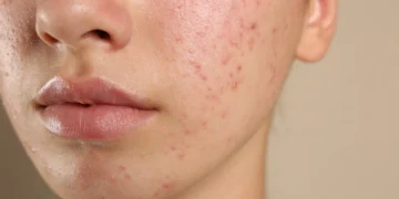 Kulit Terlampau Sensitif Terhadap Produk: Tanda Skin Barrier Rosak?