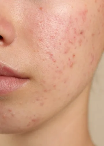 Kulit Terlampau Sensitif Terhadap Produk: Tanda Skin Barrier Rosak?