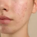 Kulit Terlampau Sensitif Terhadap Produk: Tanda Skin Barrier Rosak?