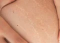 Stretch Marks: Boleh Hilang atau Tidak?