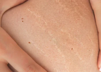 Stretch Marks: Boleh Hilang atau Tidak?
