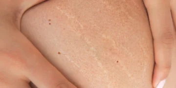 Stretch Marks: Boleh Hilang atau Tidak?