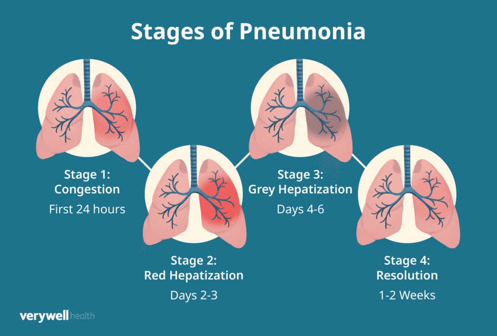 pneumonia