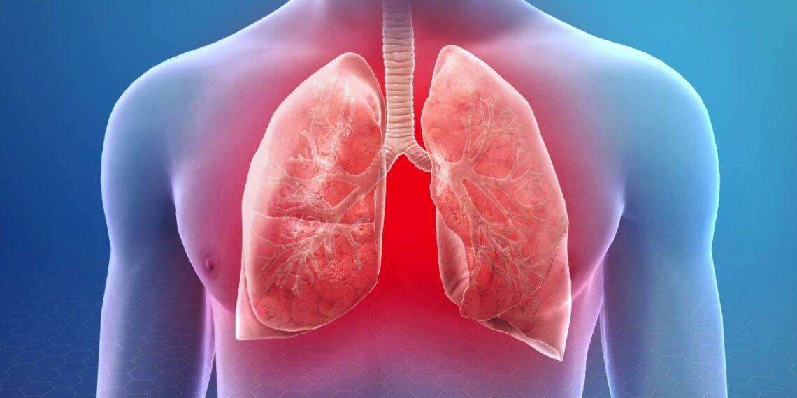 Pneumonia: Bagaimana Jangkitan Paru-Paru Boleh Menjadi Serius?