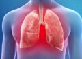 Pneumonia: Bagaimana Jangkitan Paru-Paru Boleh Menjadi Serius?