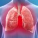 Pneumonia: Bagaimana Jangkitan Paru-Paru Boleh Menjadi Serius?