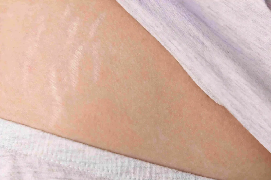 Stretch Marks