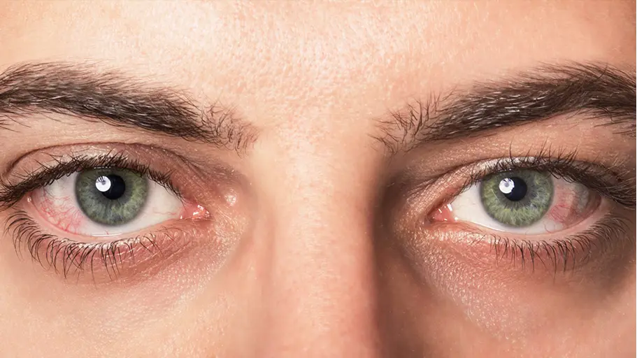 Tidur Dengan Contact Lens